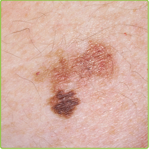 Melanoma Skin